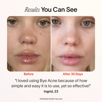 Bye Acne: 3-Minute Pimple Spot Treatment Solawave
