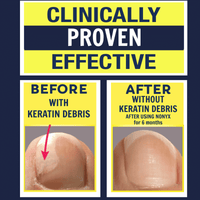 Nonyx Fungal Nail Clarifying Gel Clears Out Keratin Debris Where Nail Fungus Thrives 4 oz EasyOptionXY LLC