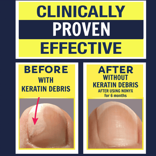 Nonyx Fungal Nail Clarifying Gel Clears Out Keratin Debris Where Nail Fungus Thrives 4 oz EasyOptionXY LLC