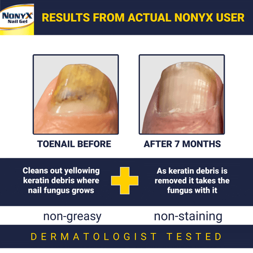 Nonyx Fungal Nail Clarifying Gel Clears Out Keratin Debris Where Nail Fungus Thrives 4 oz EasyOptionXY LLC