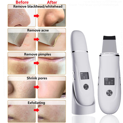 Blackhead Remover Ultrasonic Skin Scrubber Facial Pore Acne Peeling Spatula Blackhead Removal Shovel Face Deep Cleaning Device