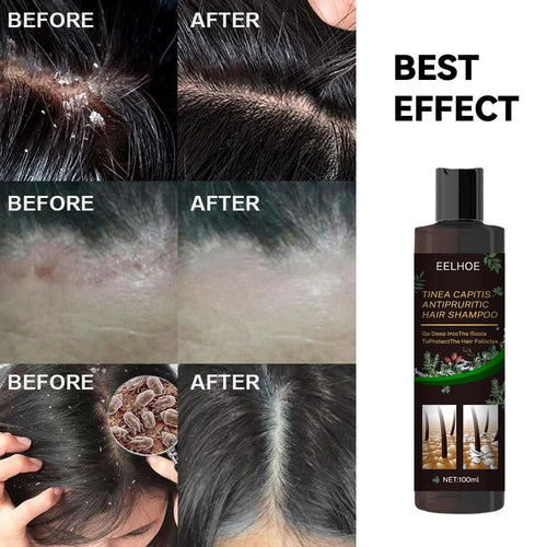 EELHOE Anti-Dandruff Shampoo - Itch Relief, Hair Loss Prevention, Oil Control & Refreshing Care EasyOptionXY LLC