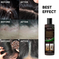 Anti-Dandruff Shampoo,Shampoo For Scalp Prone To Folliculitis, Dermatitis, Dandruff, Itchy And Flaky Scalp,Treats Dandruff And Seborrheic Dermatitis,Anti-Itch Shampoo EasyOptionXY LLC