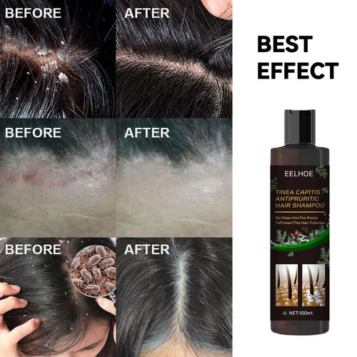 Anti-Dandruff Shampoo,Shampoo For Scalp Prone To Folliculitis, Dermatitis, Dandruff, Itchy And Flaky Scalp,Treats Dandruff And Seborrheic Dermatitis,Anti-Itch Shampoo EasyOptionXY LLC