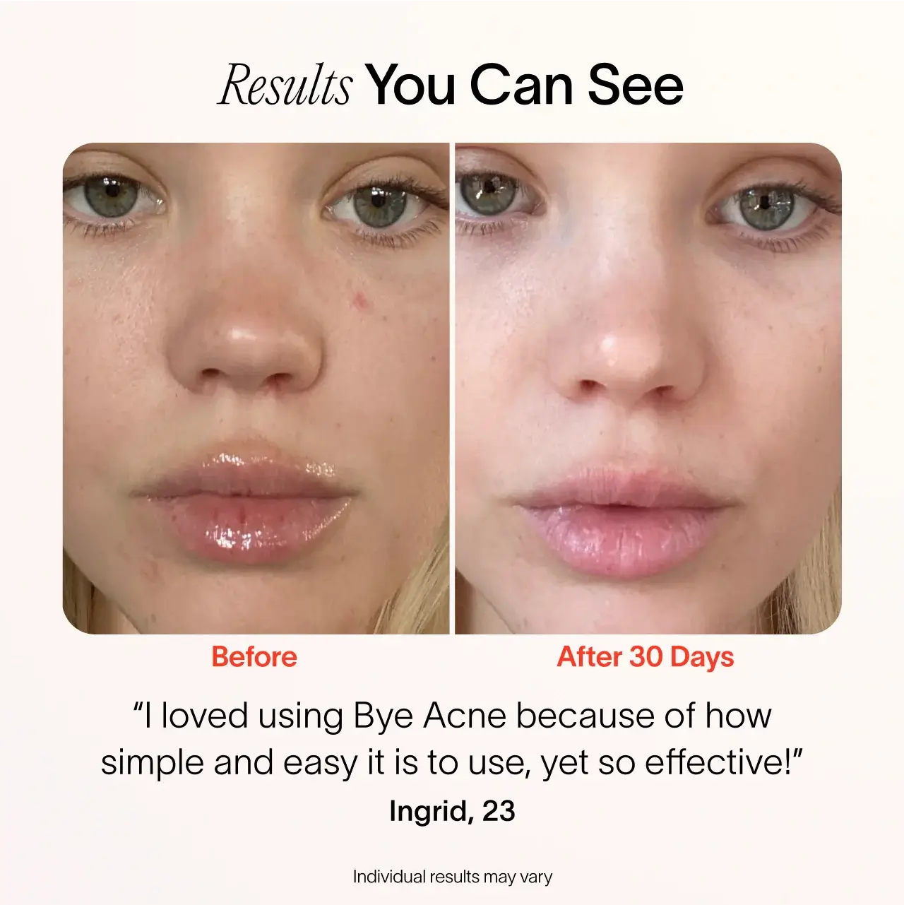 Solawave Solawave Bye Acne: 3-Minute Pimple Spot Treatment