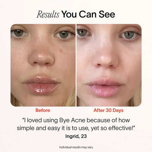 Bye Acne: 3-Minute Pimple Spot Treatment Solawave