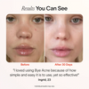 Bye Acne: 3-Minute Pimple Spot Treatment