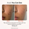 Bye Acne: 3-Minute Pimple Spot Treatment Solawave