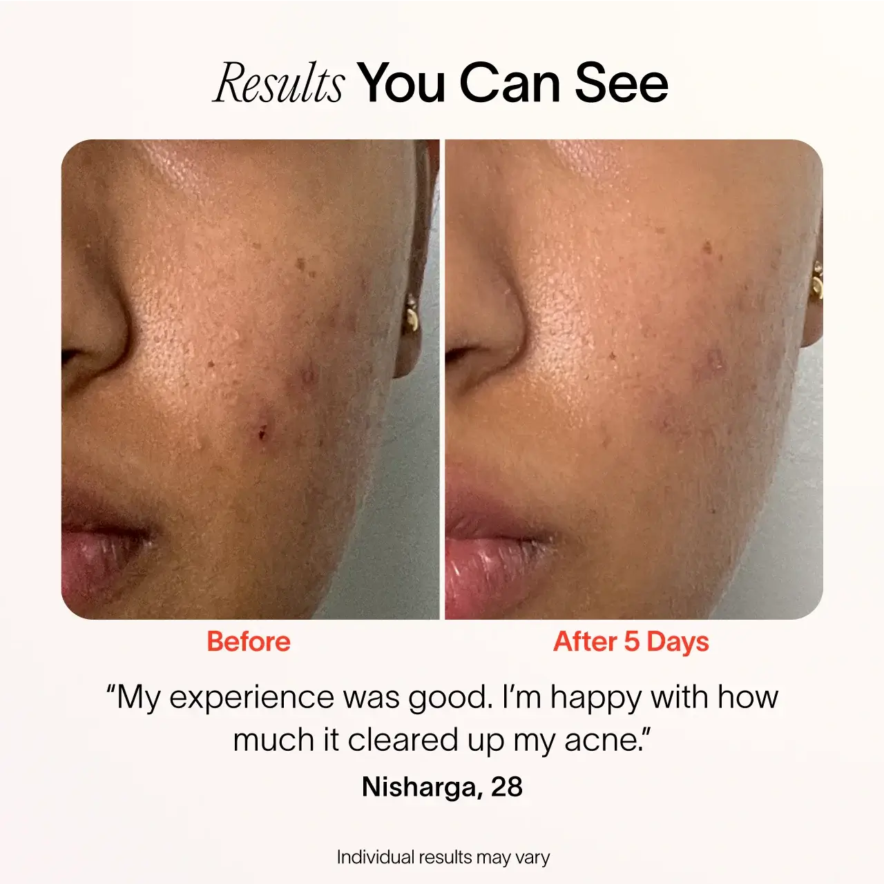 Solawave Solawave Bye Acne: 3-Minute Pimple Spot Treatment
