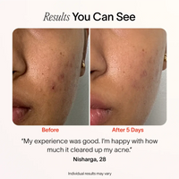 Bye Acne: 3-Minute Pimple Spot Treatment Solawave